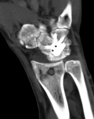 Figure 3 for case surgical carpal fusion ( RID2240 )